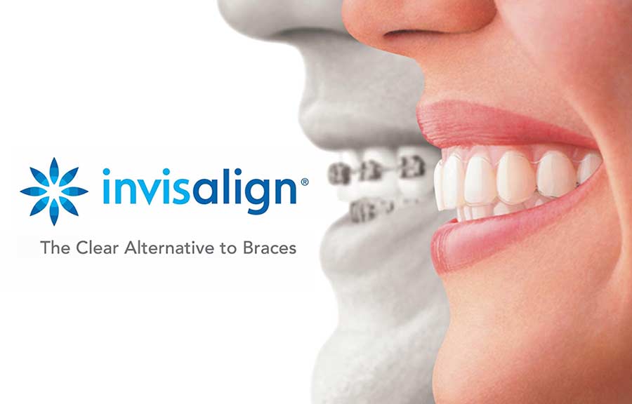 Metal braces vs Invisalign treatment – Arya Dental Clinic