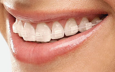 clear braces
