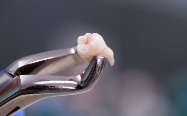 wisdom tooth extraction