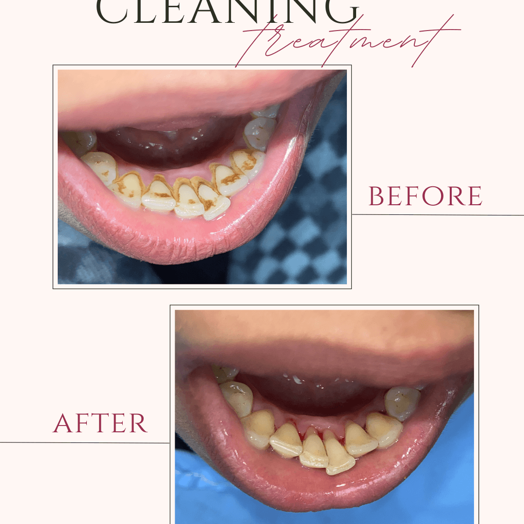 Beige and Pink Elegant Brows Treatment Before After Instagram Post (1)