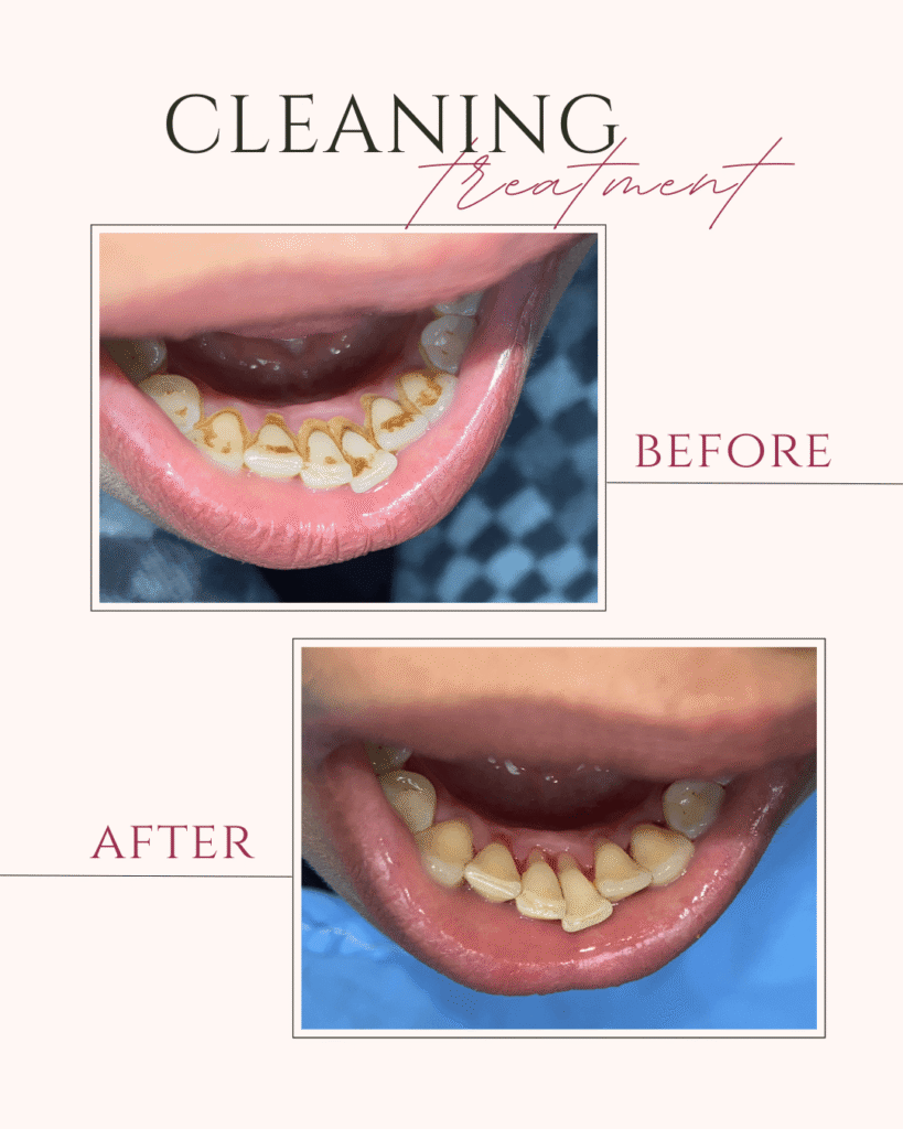 Beige and Pink Elegant Brows Treatment Before After Instagram Post (1)