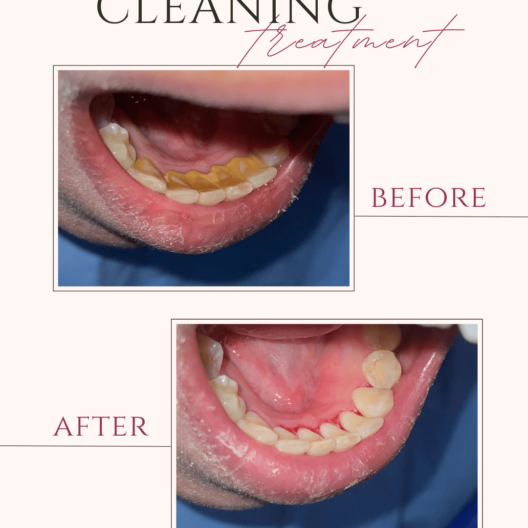 Beige and Pink Elegant Brows Treatment Before After Instagram Post (2)