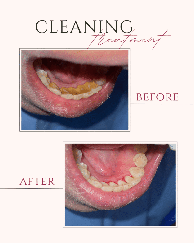 Beige and Pink Elegant Brows Treatment Before After Instagram Post (2)