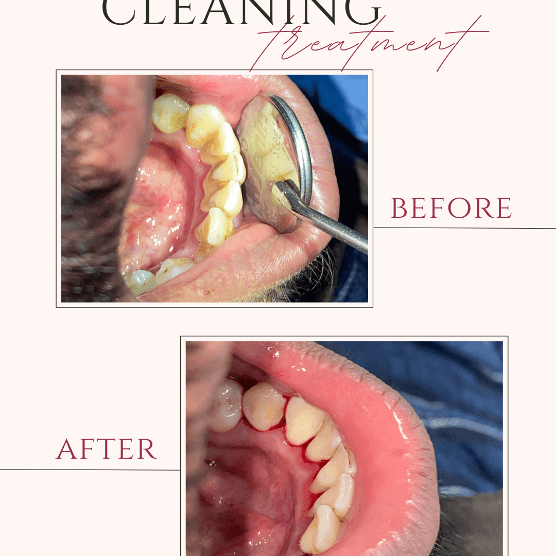 Beige and Pink Elegant Brows Treatment Before After Instagram Post (3)