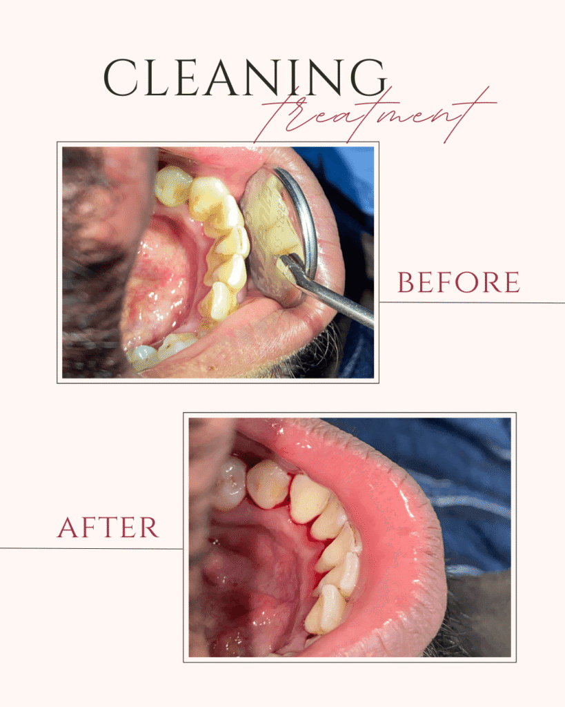 Beige and Pink Elegant Brows Treatment Before After Instagram Post (3)