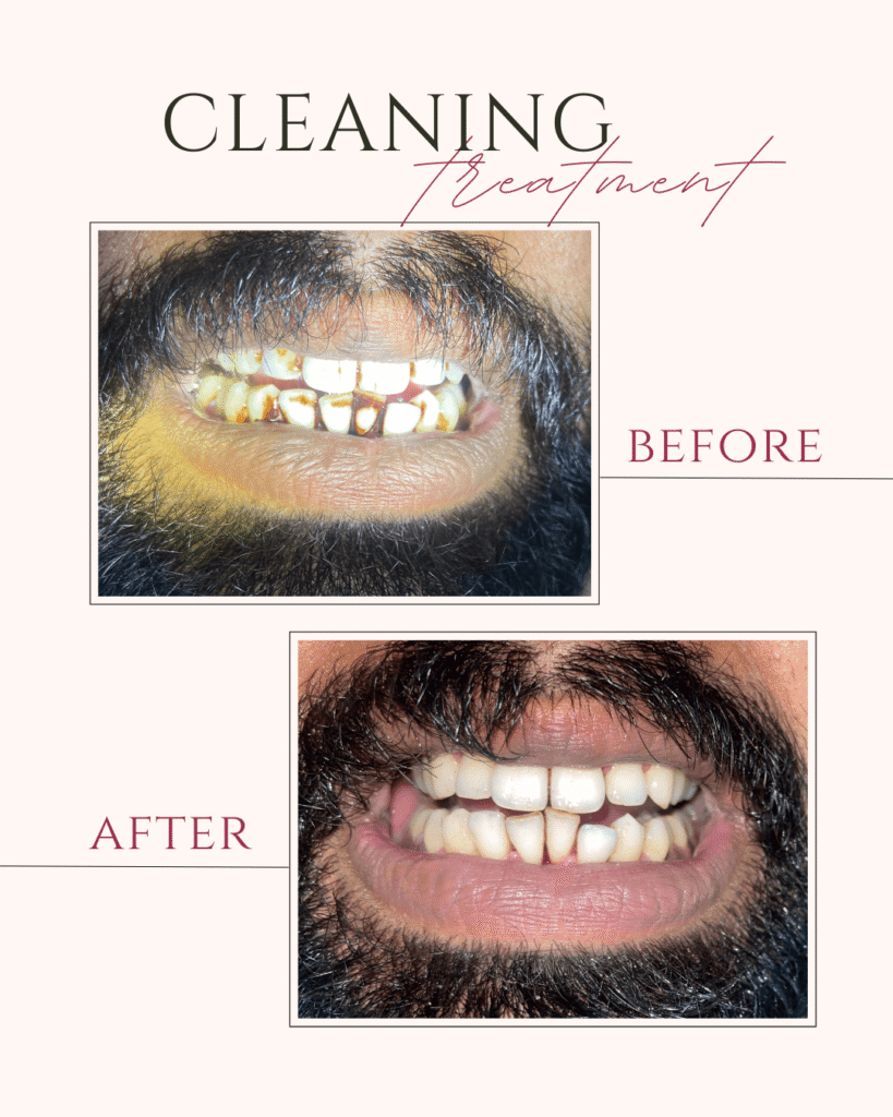 Beige and Pink Elegant Brows Treatment Before After Instagram Post (6)