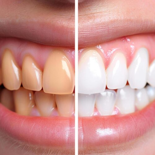 WHITENING