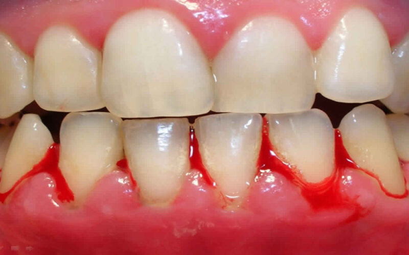 bleeding gums