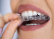 clear aligners