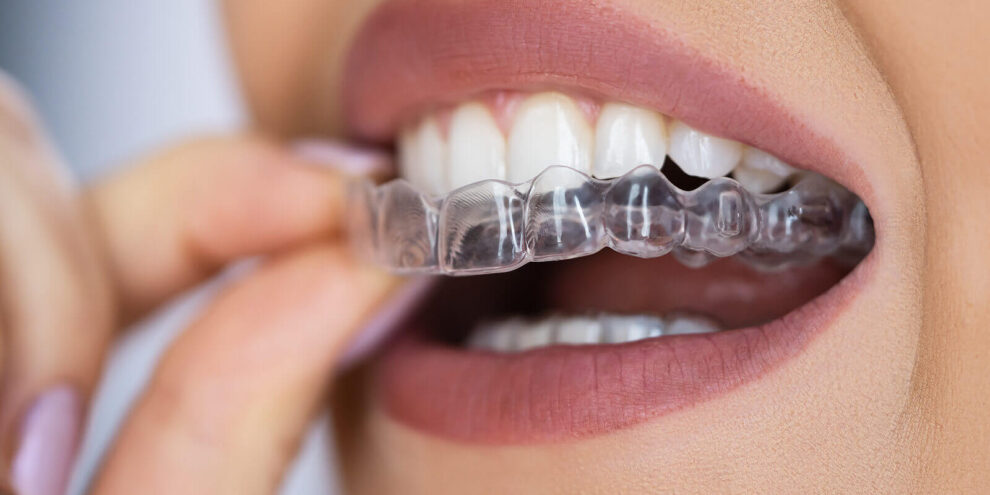clear aligners