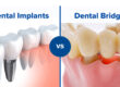 implant vs bridge