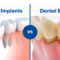 implant vs bridge