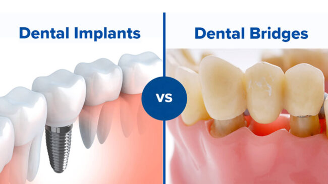 implant vs bridge implant vs bridge