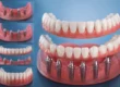 Full Mouth Dental Implants​ in Gomtinagar
