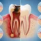 What is Root Canal Treatment​